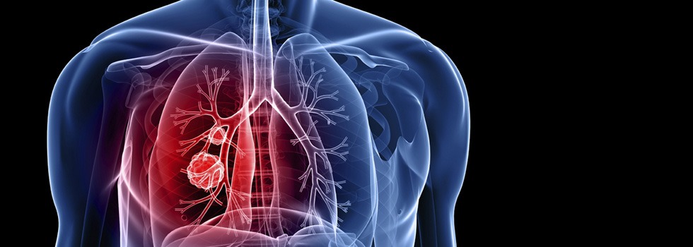 Low Dose Lung Screening Bluegrass Regional Imaging