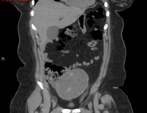 Abdominal CT Scan