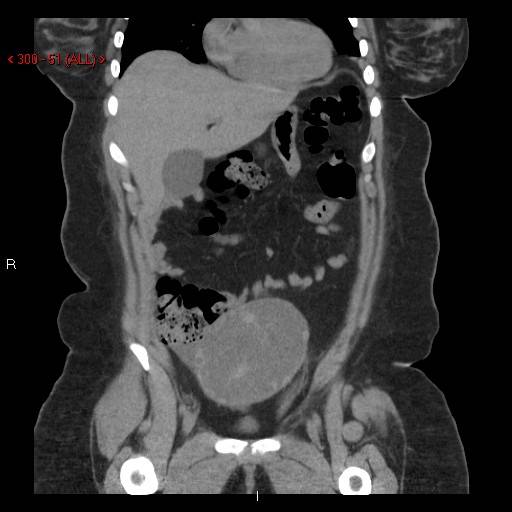 Abdominal Ct Scan Bluegrass Regional Imaging