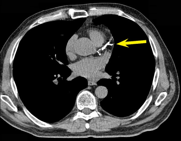 Heart Scan - Coronary Calcium Scan | Bluegrass Regional ...