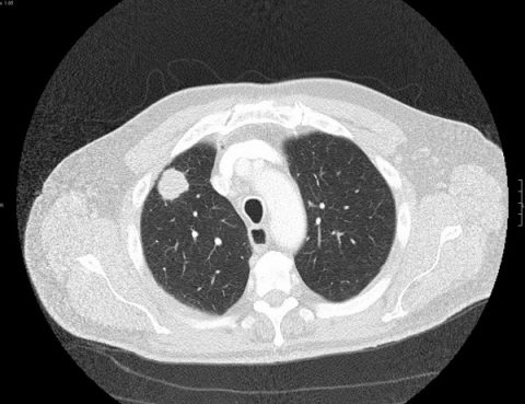 CT Screeing for Lung Cancer