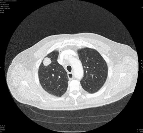 CT Screeing for Lung Cancer