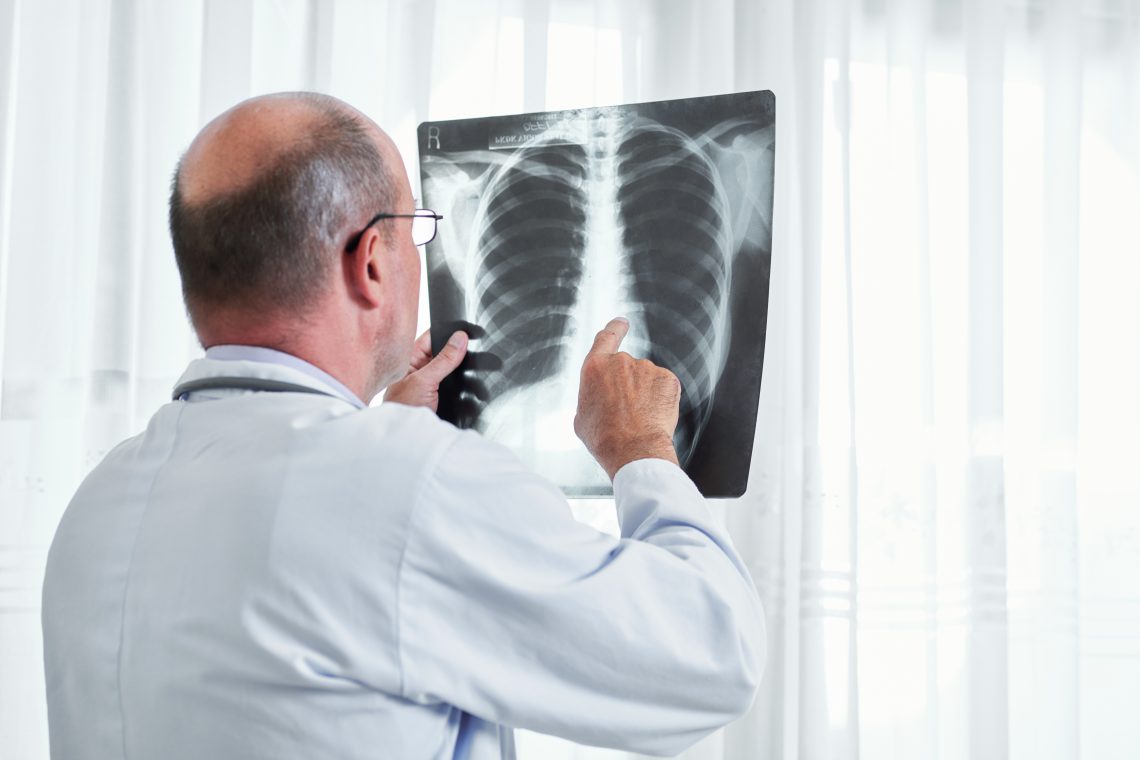 mesothelioma symptoms adults