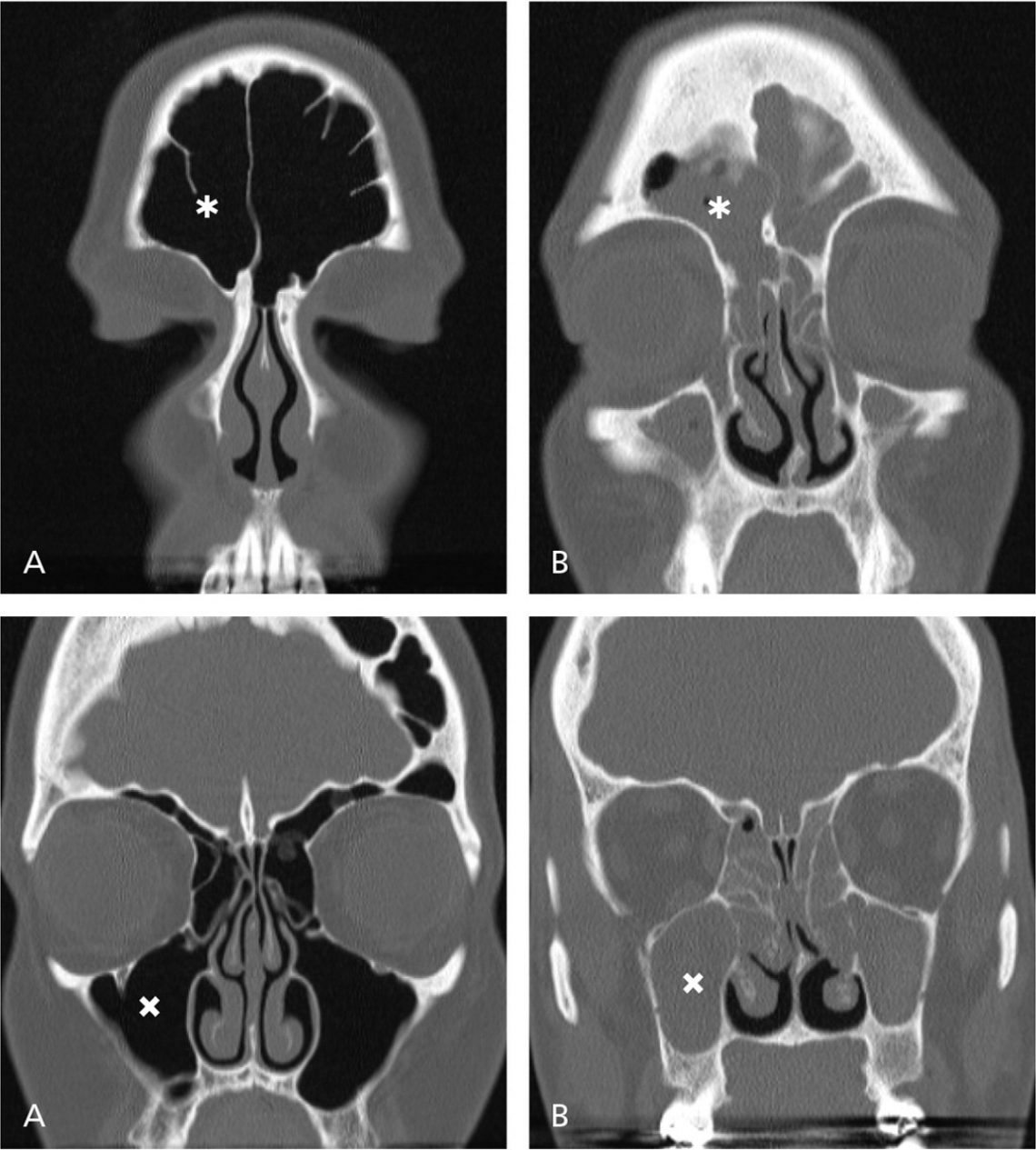 recurrent nasal congestion