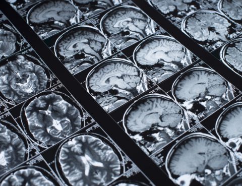 PET Scans and Alzheimers