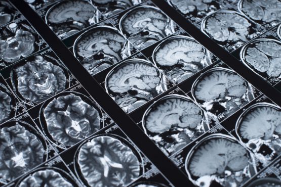 PET Scans and Alzheimers