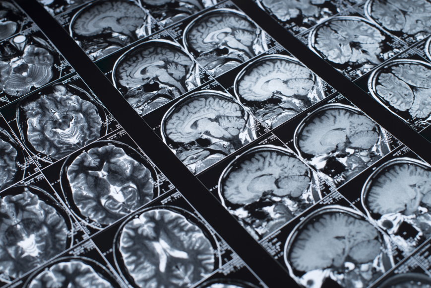 PET Scans and Alzheimers