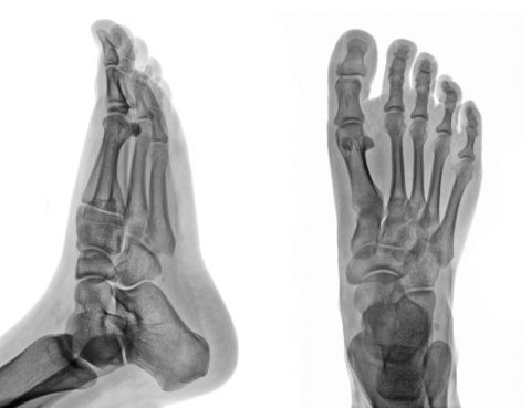 Foot CT PET scan