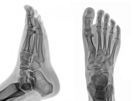 Foot CT PET scan